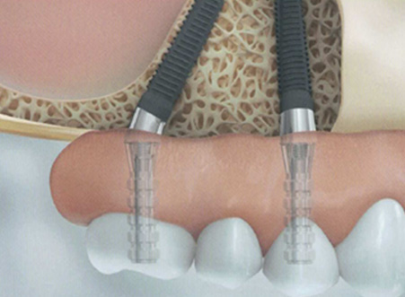 All-On-4®  / hochmoderne feste Zähne an einem Tag - Zahnarzt Murg