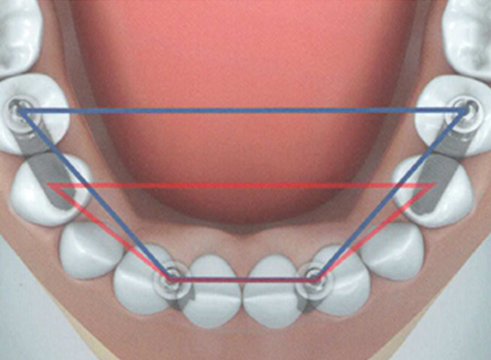 All-On-4®  / hochmoderne feste Zähne an einem Tag - Zahnarzt Murg